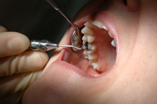 虫歯治療 イメージ画像