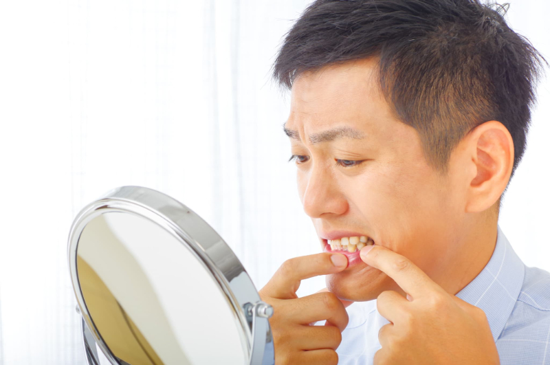 歯周病になった歯ぐきを鏡で確認する男性