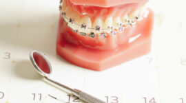 歯の矯正治療にはどれくらいの期間がかかるのか説明するイメージ