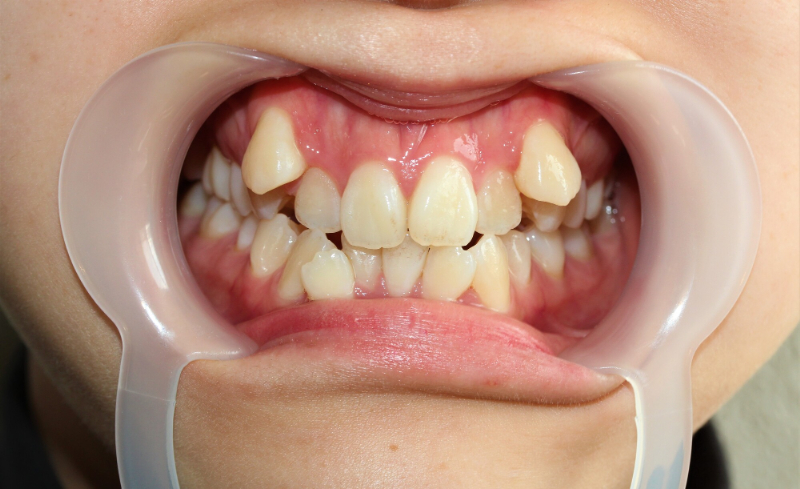 八重歯が目立つ口元