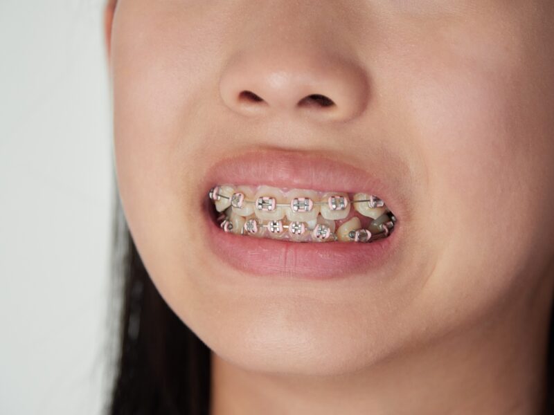 すきっ歯の治療でワイヤー矯正をする子ども