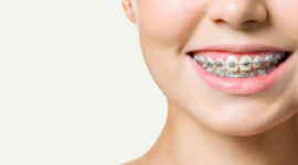 ワイヤー矯正をした口のイメージ