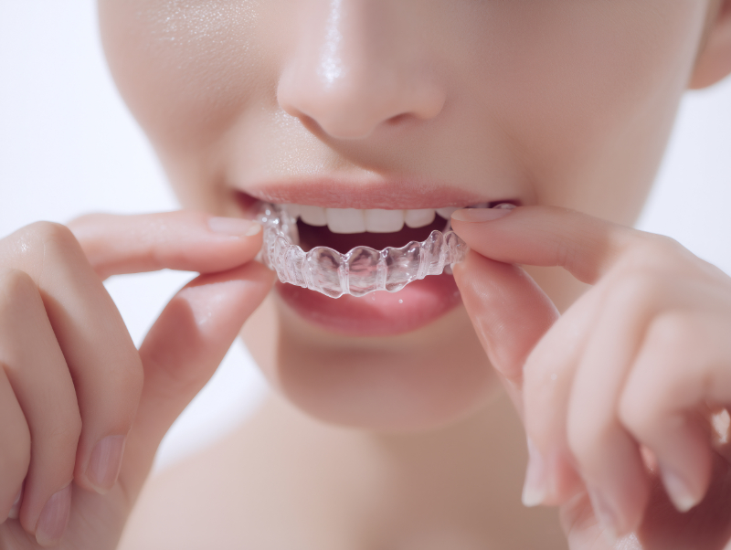インビザラインのマウスピースを装着する妊婦