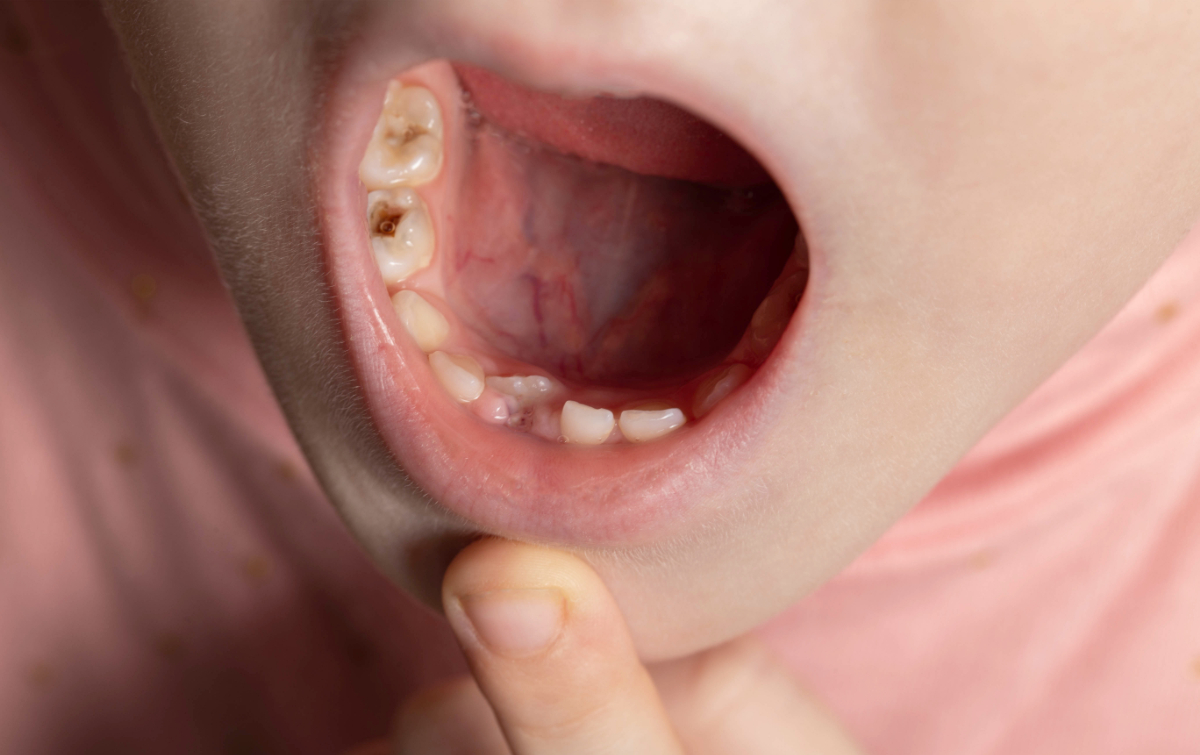 ひどい虫歯になっている子どもの歯