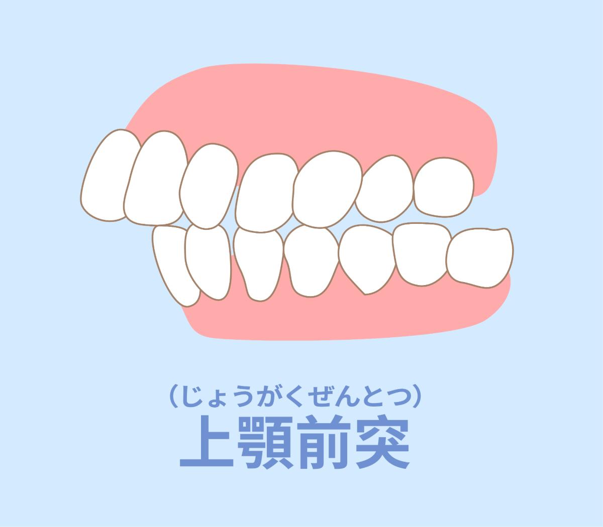 出っ歯の構造